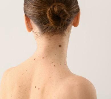 Znamiona na skórze Które są niebezpieczne i kiedy je usunąć