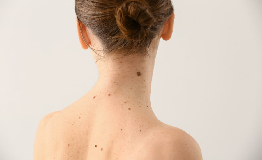 Znamiona na skórze Które są niebezpieczne i kiedy je usunąć